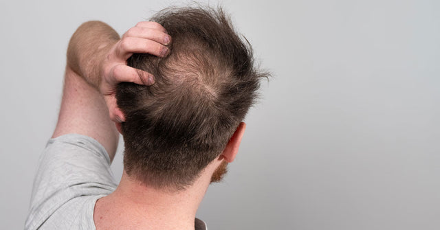 Early signs of balding 10 warning signs and how to stop hair loss