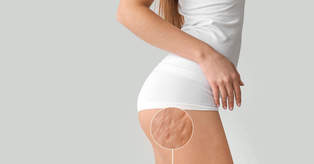 Stretch marks on butt causes how to get rid of them and prevention