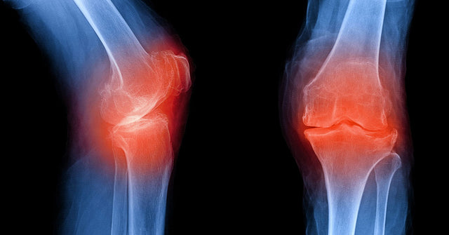 Subchondral sclerosis bone thickening below joint cartilage osteoarthritis